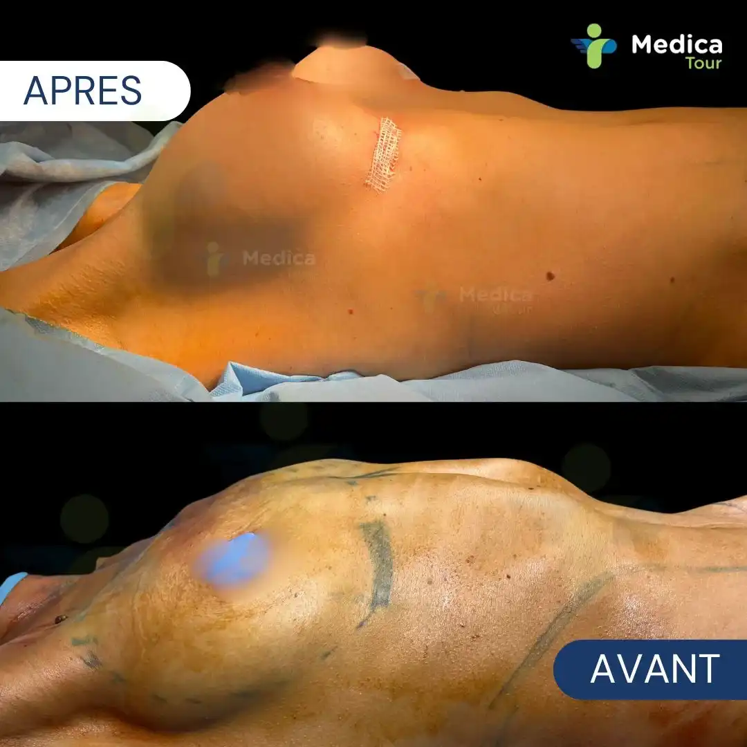 Résultat avant/après augmentation mammaire en Tunisie
