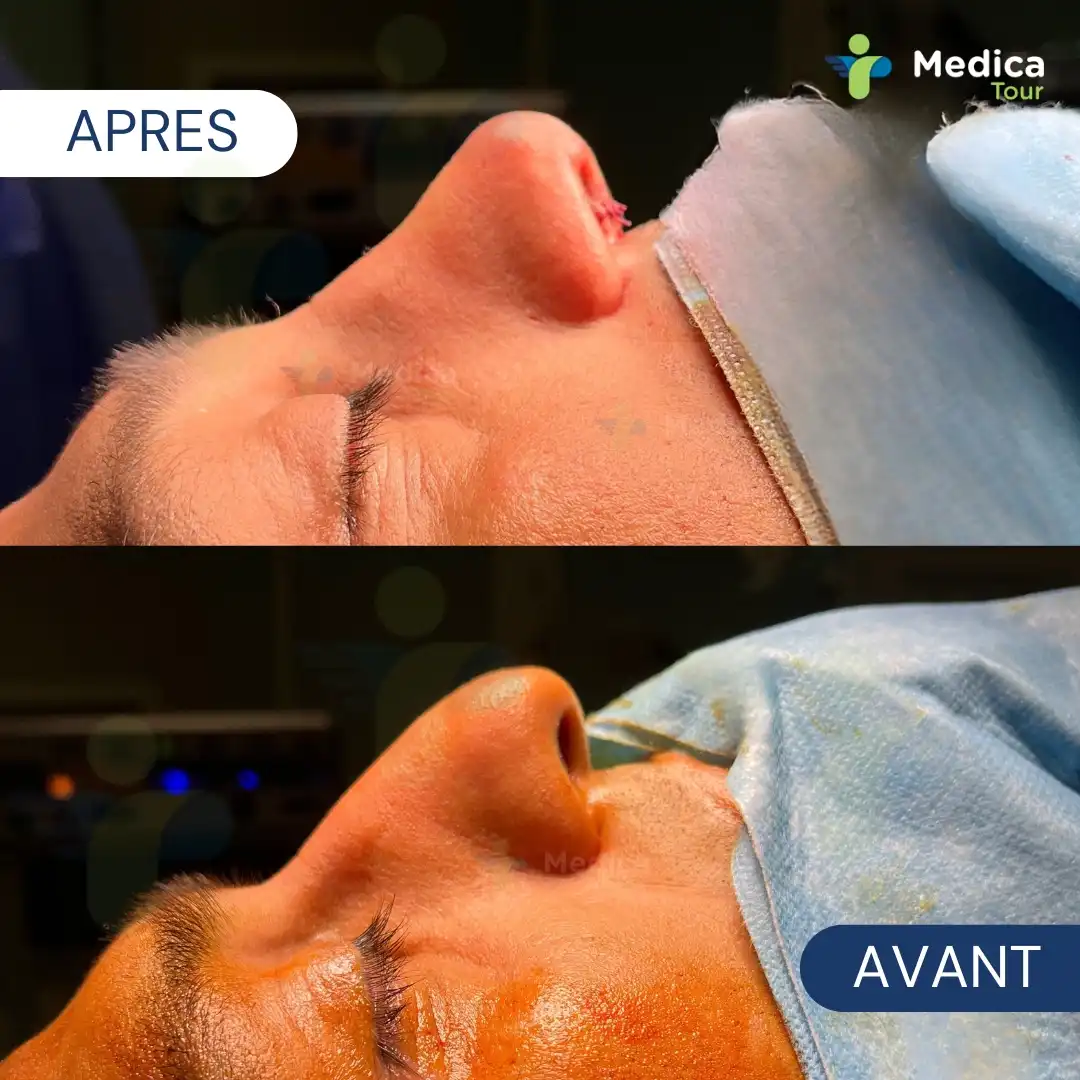 Résultat avant/après rhinoplastie en Tunisie