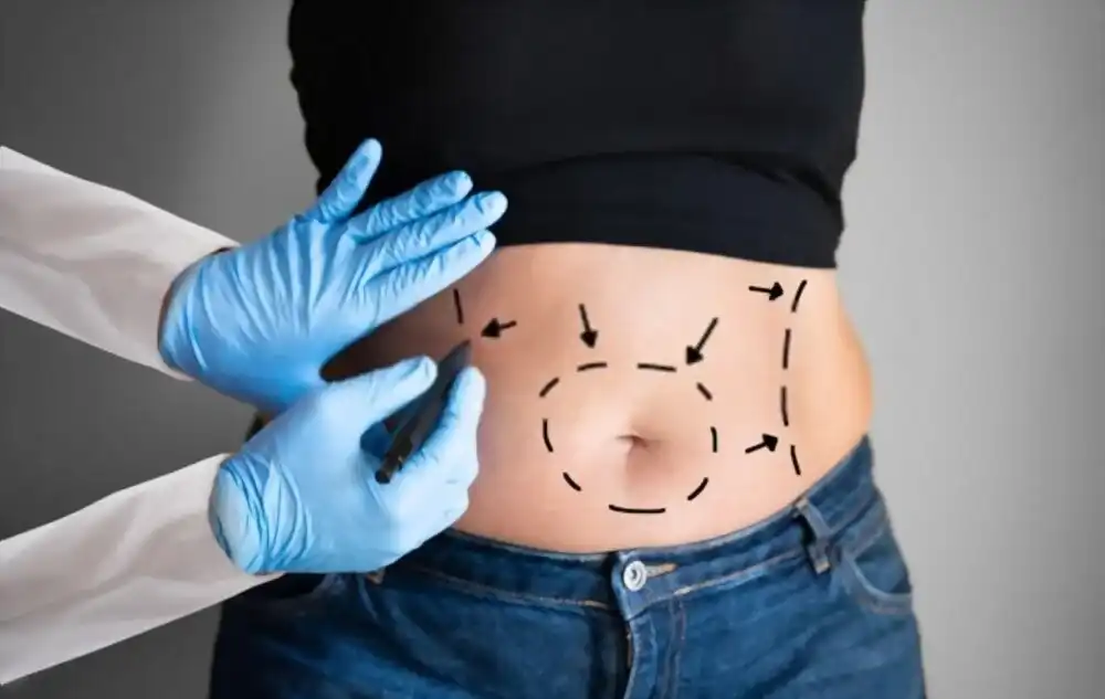 Mini abdominoplastie tunisie