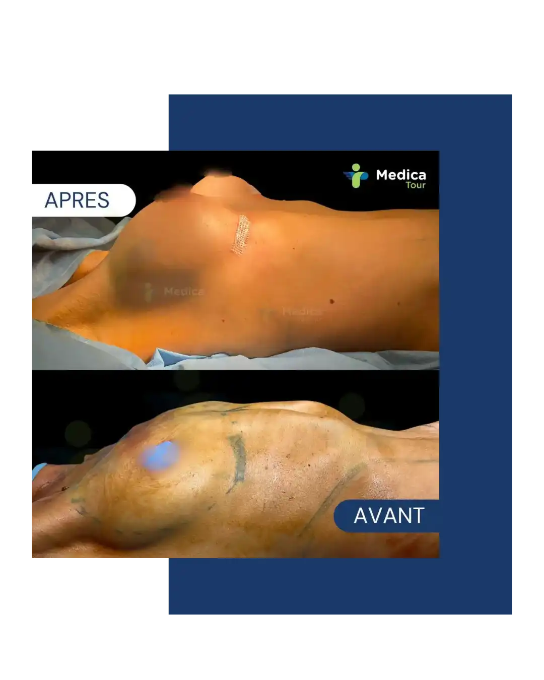 Résultat avant/après augmentation mammaire en Tunisie